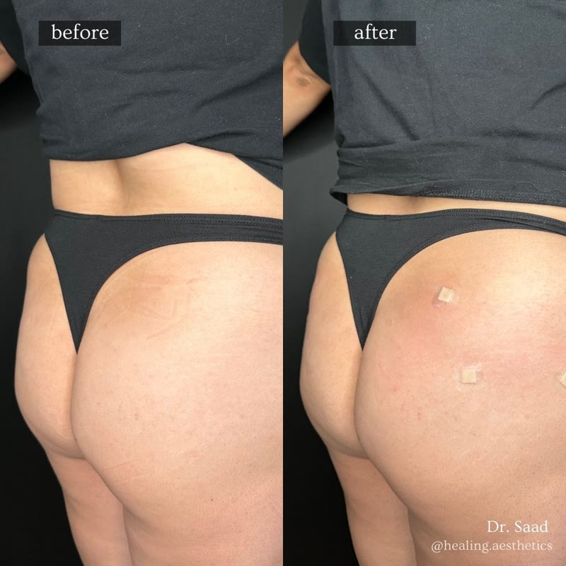 Sculptra before and after - butt BBL volume enhancement