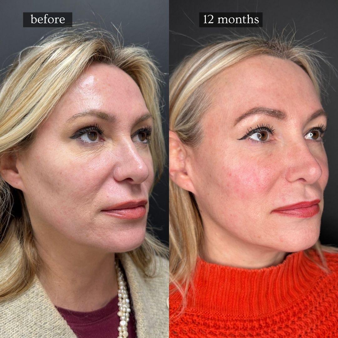 Sculptra before and after face results at 12 months
