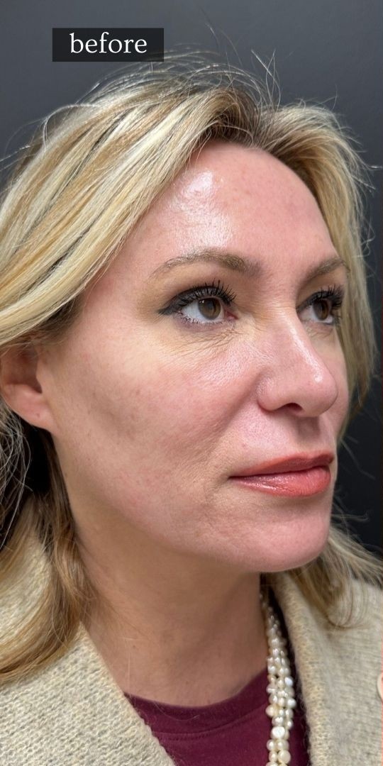 Face before Sculptra treatment