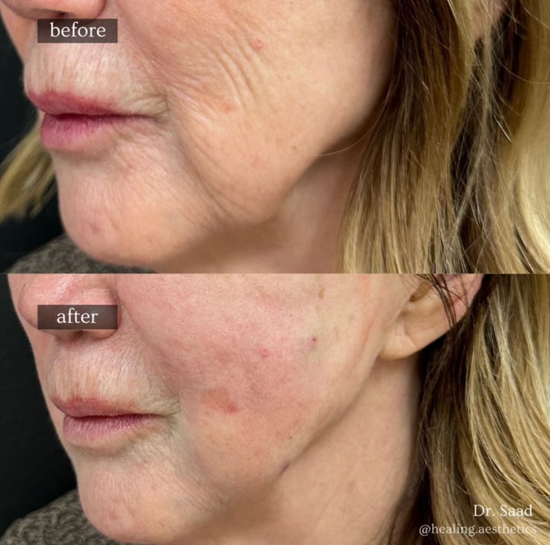 Sculptra before and after face treatment results at Healing Aesthetics Hinsdale