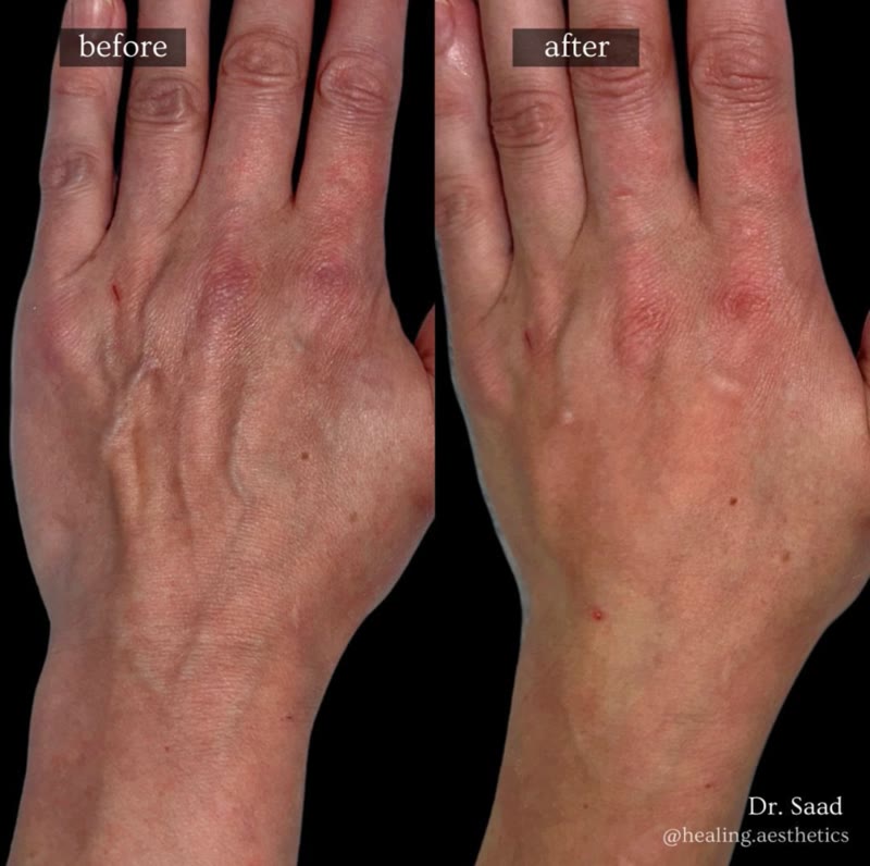Sculptra before and after - hand rejuvenation and volume restoration