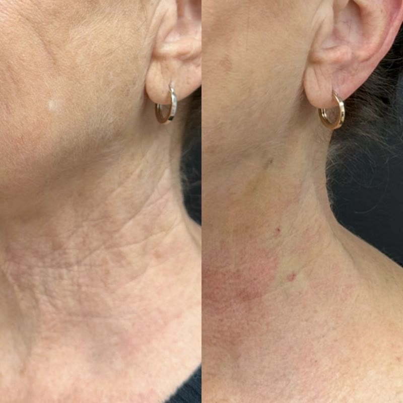 Sculptra before and after jawline definition results