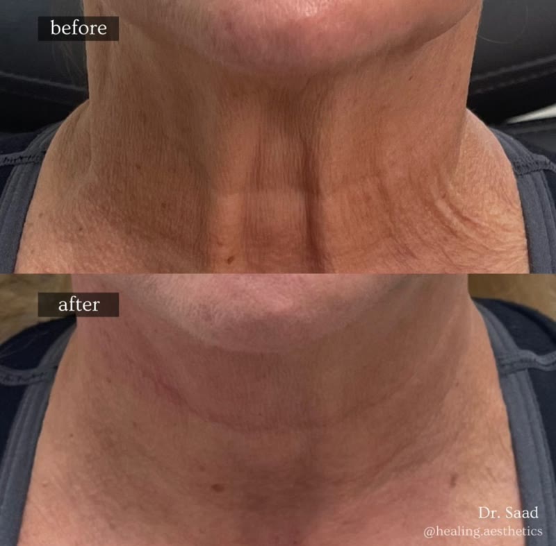 Sculptra before and after neck rejuvenation results