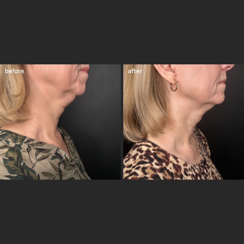 Sculptra before and after - face and neck rejuvenation